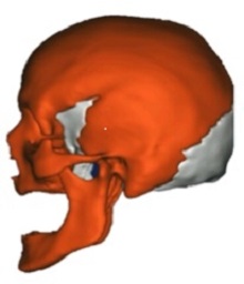 3D-FEA of the Relationship between the Occiput and Sphenoid in the ...