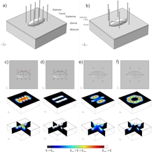 Estudo Numérico da Eletroquimioterapia em Tumor Cutâneo com Diferentes ...