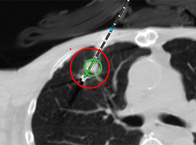 Medtronic Advances Ablation Technology with Multiphysics Simulation